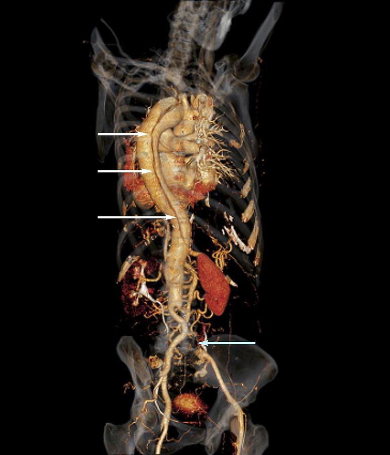 3-d Photograph - Aortic Aneurysm Ct Scan #4 by Zephyr