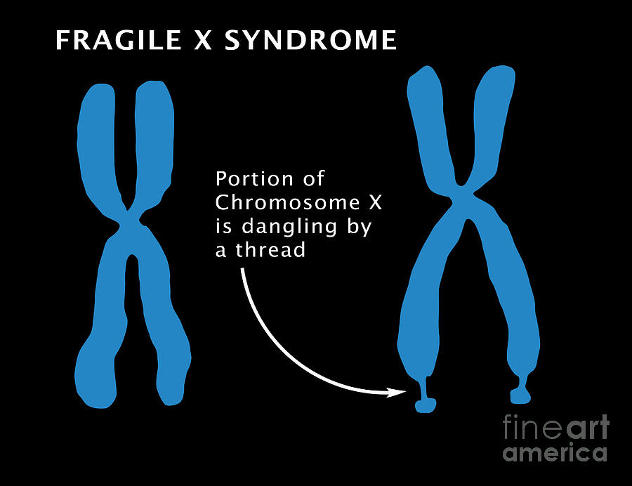 Fragile X Syndrome Photograph By Monica Schroeder
