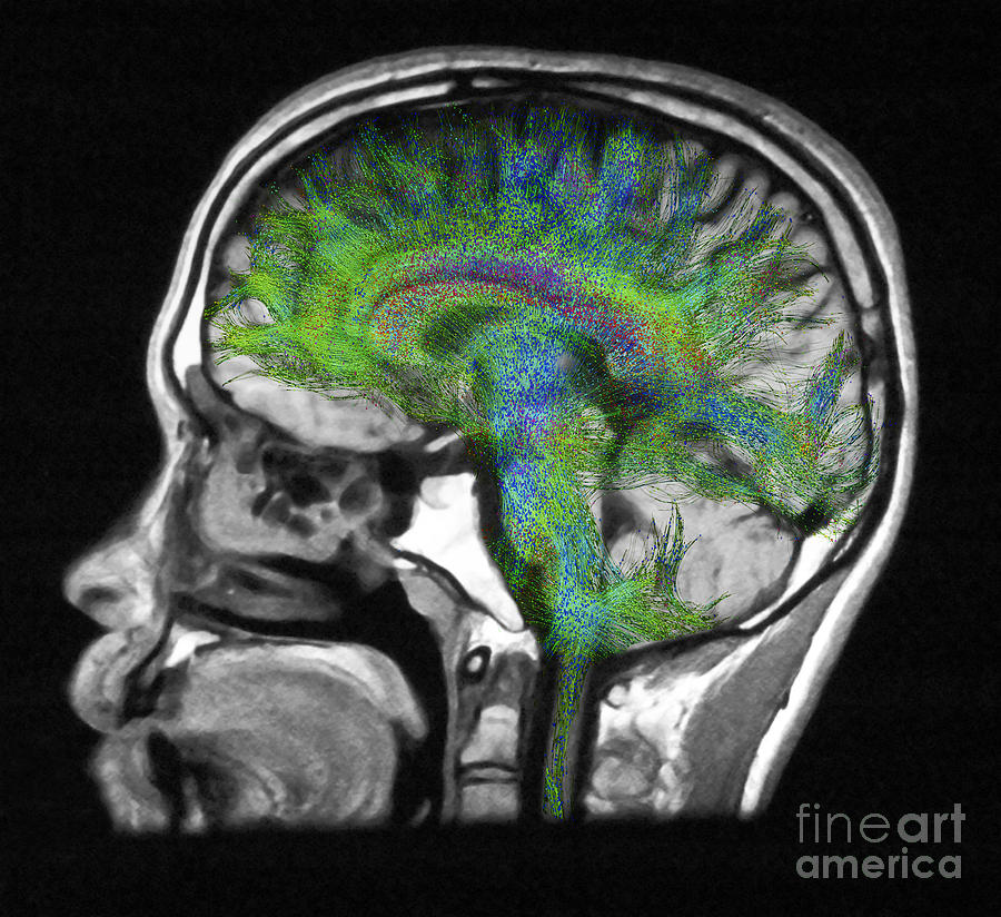 Normal Brain, Fiber Tractography And Mri #4 Photograph by Scott Camazine