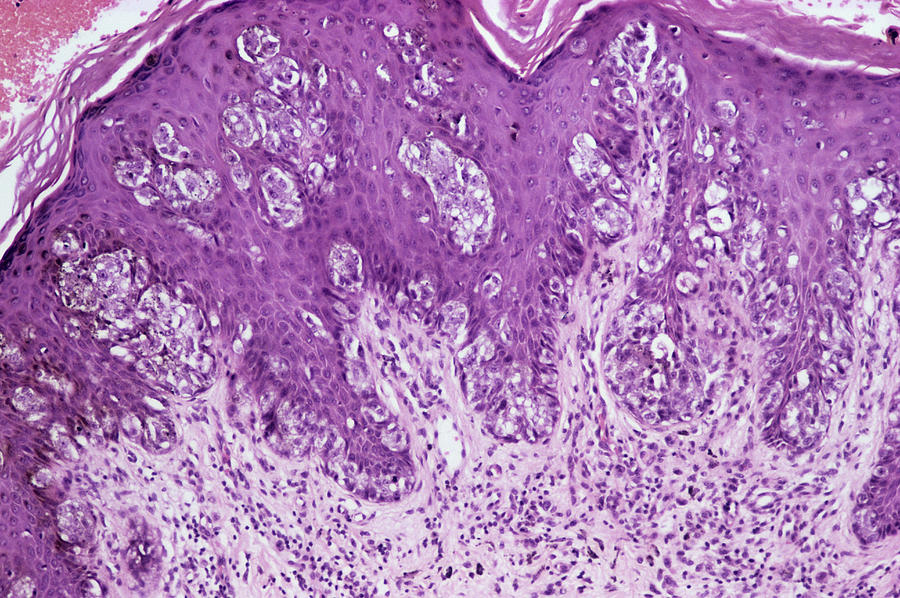 Malignant Melanoma Photograph - Skin Cancer #4 by Dr. E. Walker