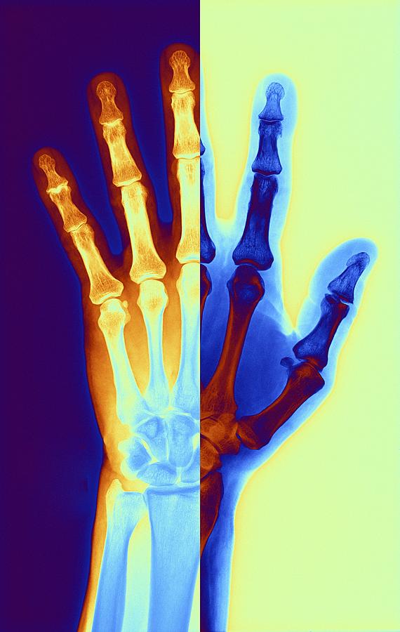Vertical Digital Art - Arthritic Hand, X-ray #5 by Pasieka