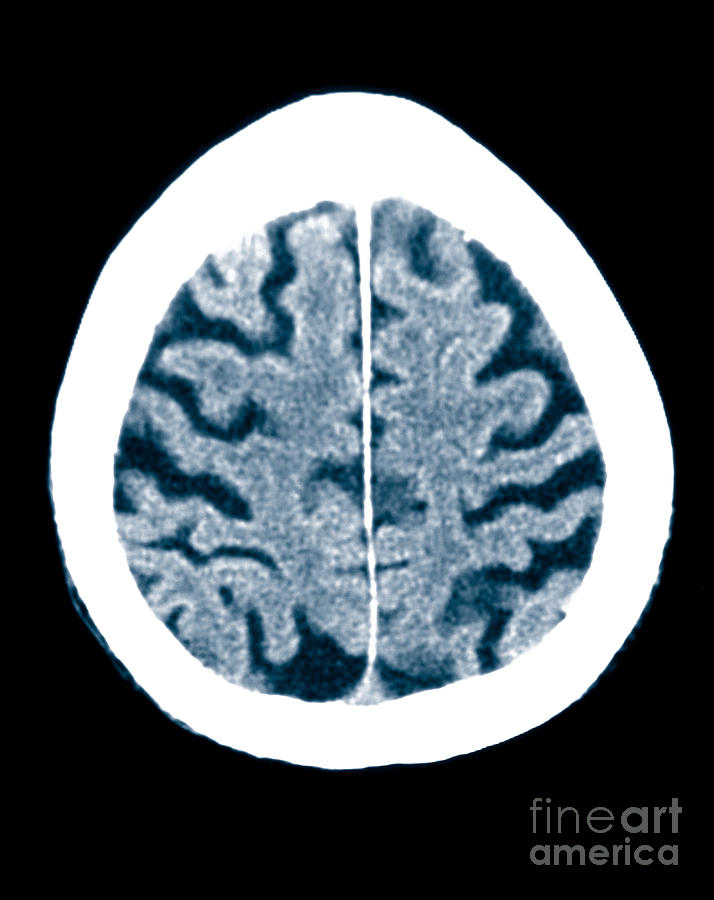 Brain Of Alzheimers Patient, Ct Scan #5 Photograph by Scott Camazine