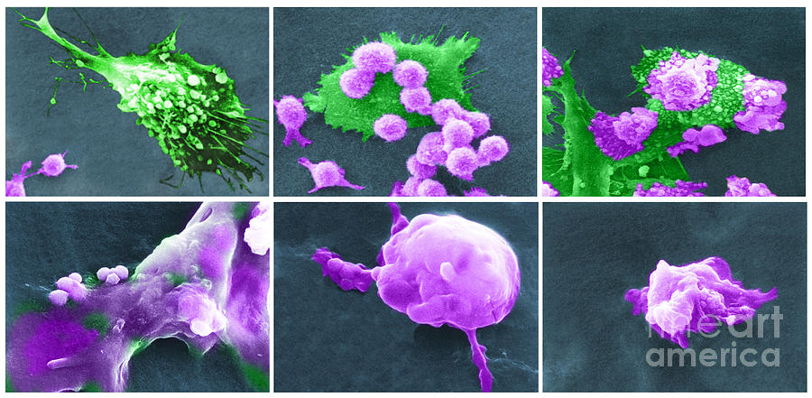 Cancer Cell Death Sequence, Sem #5  by Science Source