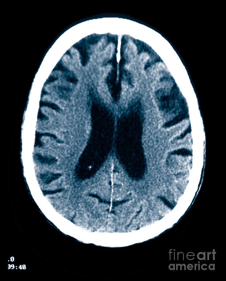 Brain Of Alzheimers Patient, Ct Scan #6 Photograph by Scott Camazine