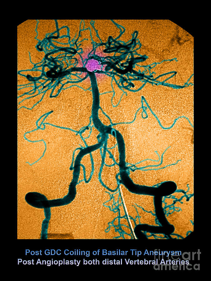 Abnormal Blood Vessel Photograph - Cerebral Angiogram #6 by Medical Body Scans