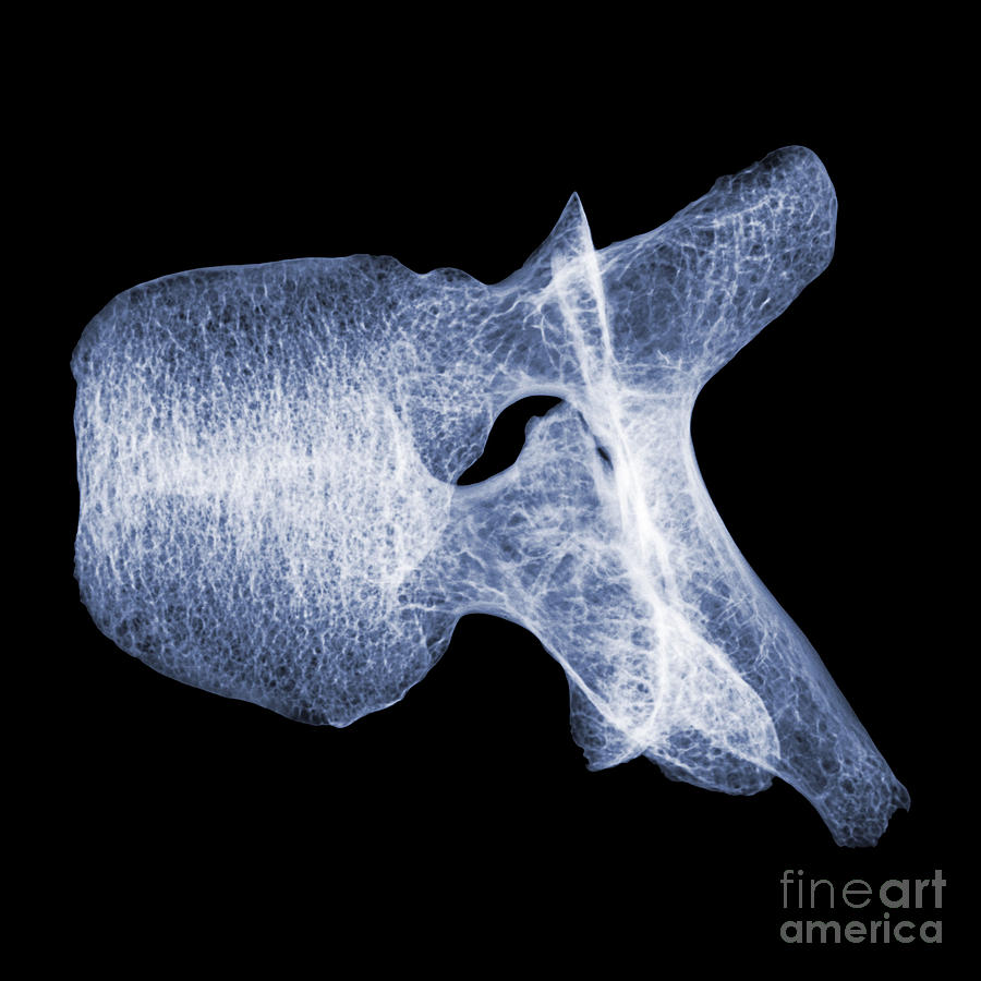 Human Vertebra T5, X-ray #6 Photograph by Ted Kinsman