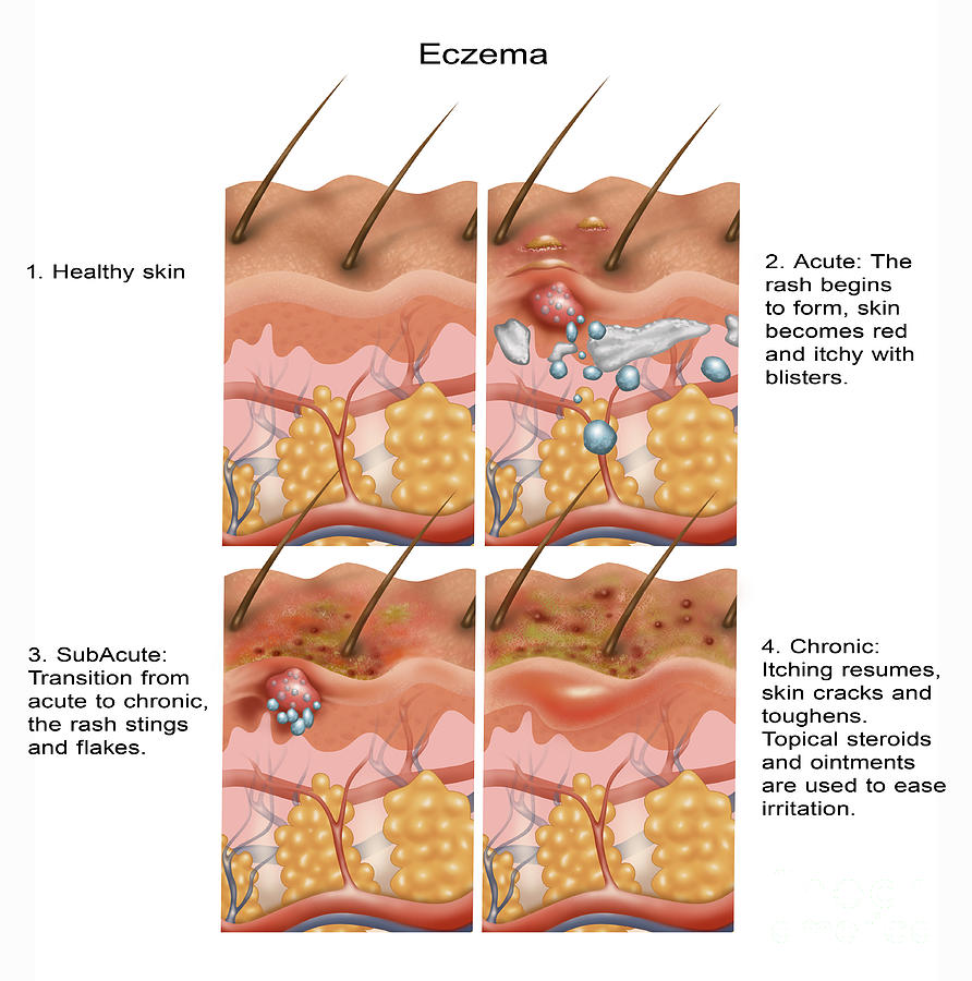 Eczema #7 Photograph by Gwen Shockey