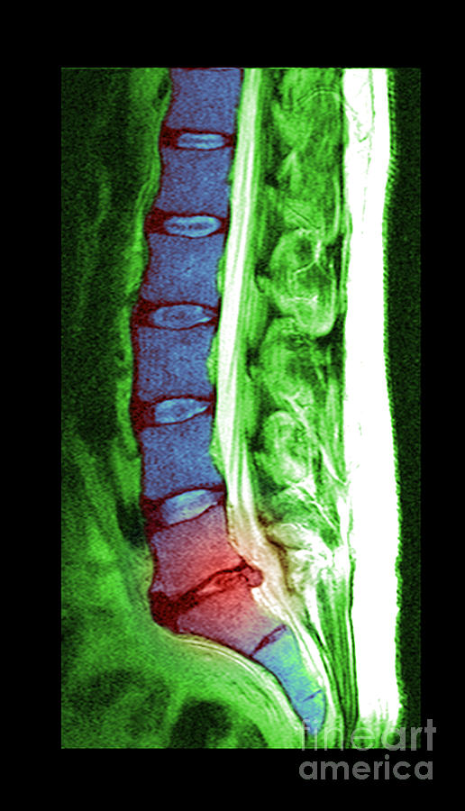 Herniated Disc #10 Photograph by Medical Body Scans