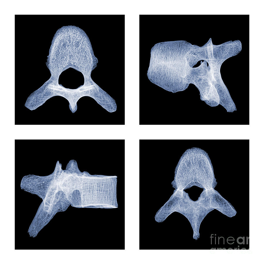 Human Vertebra T5, X-ray #1 Photograph by Ted Kinsman