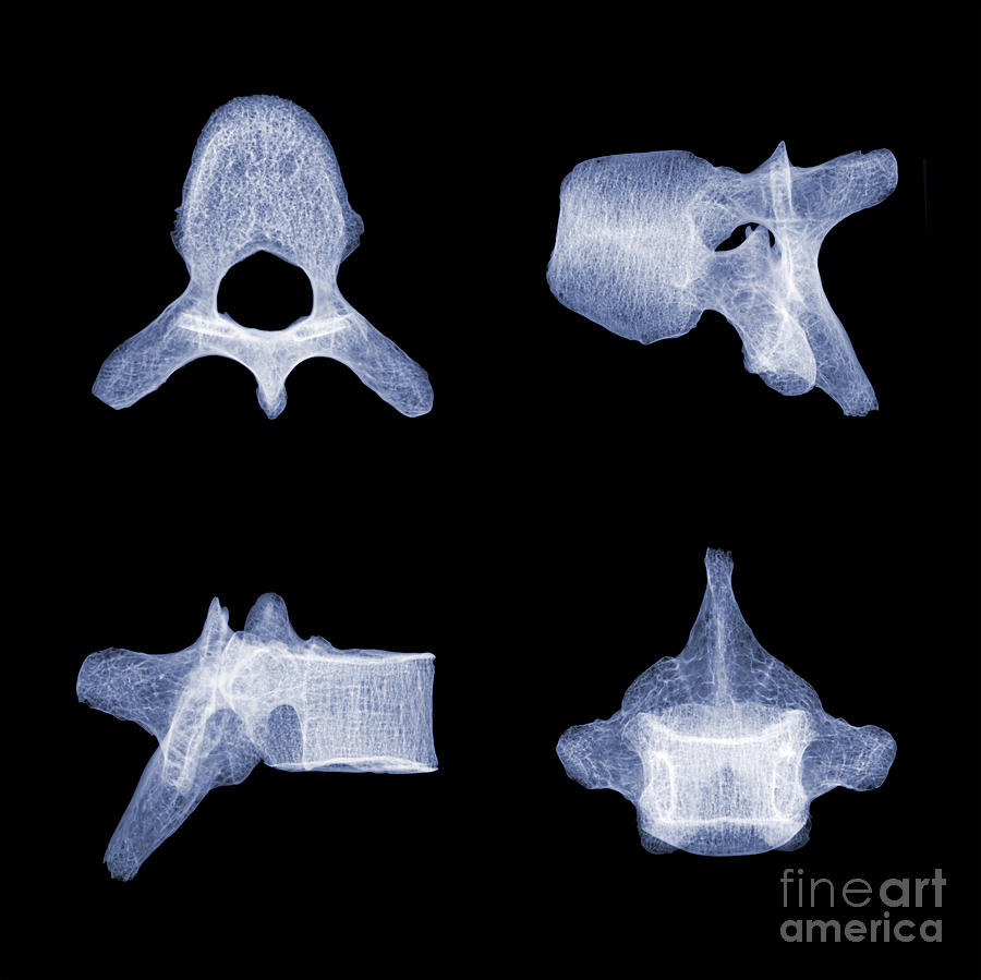 Human Vertebra T5, X-ray #9 Photograph by Ted Kinsman