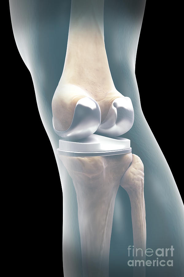 Knee Replacement #9 Photograph by Science Picture Co