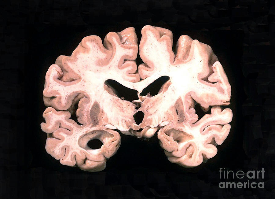 Alzheimer Brain, Gross Specimen Photograph by Science Source
