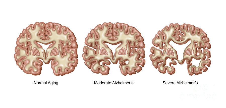 Alzheimers Brain Deterioration Photograph by Gwen Shockey