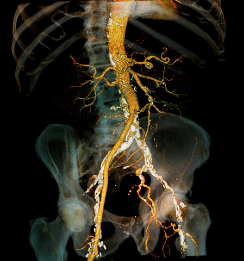 Human Photograph - Arteritis, 3d Ct Scan by Zephyr