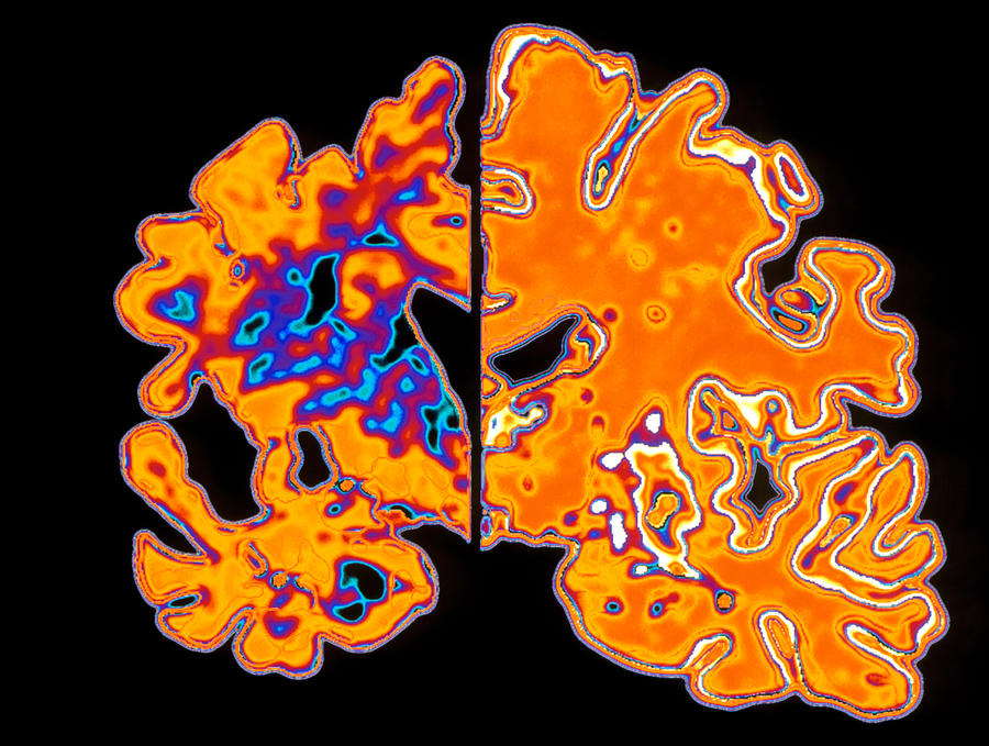 Artwork Of Alzheimers Diseased Brain Vs Normal Photograph by Pasieka
