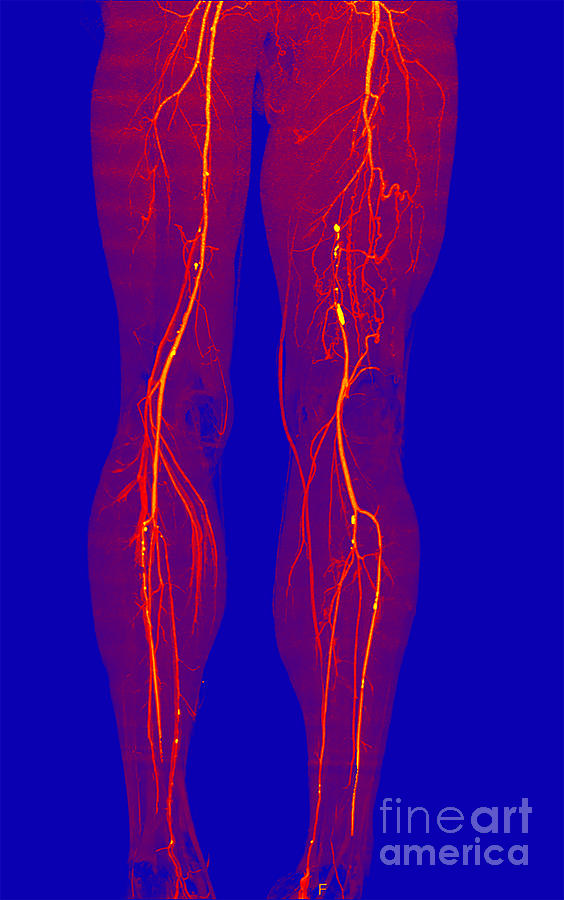 Atherosclerosis, Ct Angiogram Photograph by Living Art Enterprises