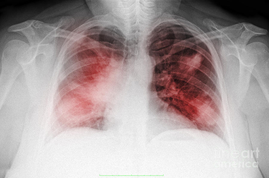 Atypical Pneumonia In Smoker, X-ray Photograph by Scott Camazine