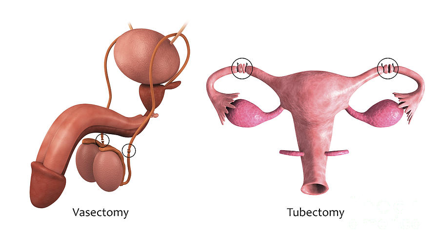 Horizontal Digital Art - Biomedical Illustration Of A Vasectomy by Stocktrek Images