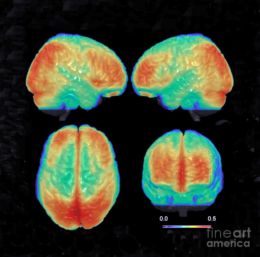 Bipolar Brain, 3d Mri Scan Photograph by Science Source
