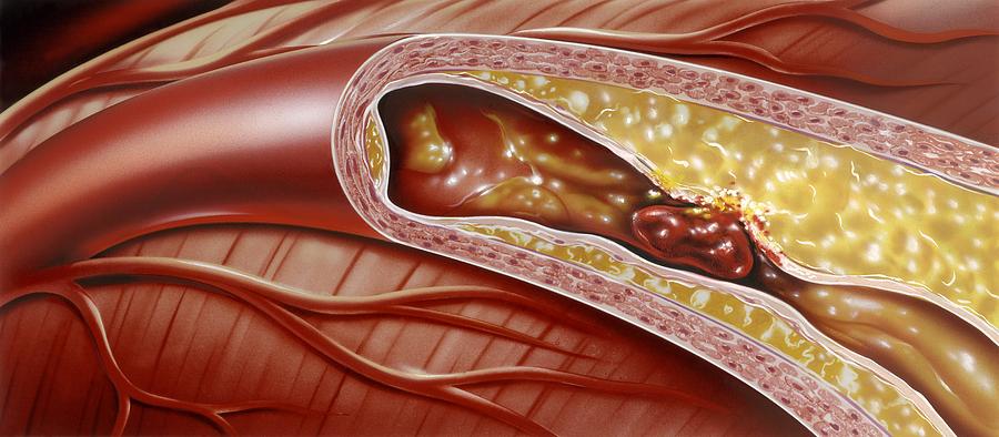Atherosclerosis Photograph - Blocked Coronary Artery, Artwork by John Bavosi
