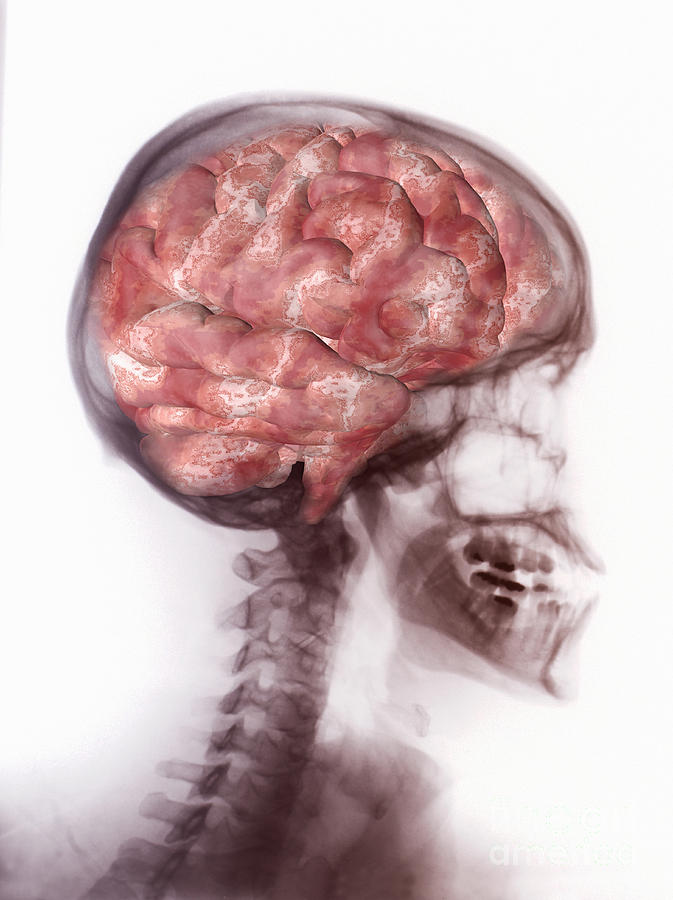 Brain Inside Skull, Artwork On X-ray Photograph by Scott Camazine