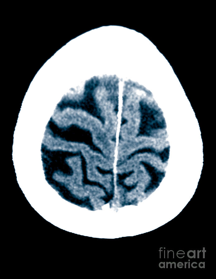 Brain Of Alzheimers Patient, Ct Scan Photograph by Scott Camazine