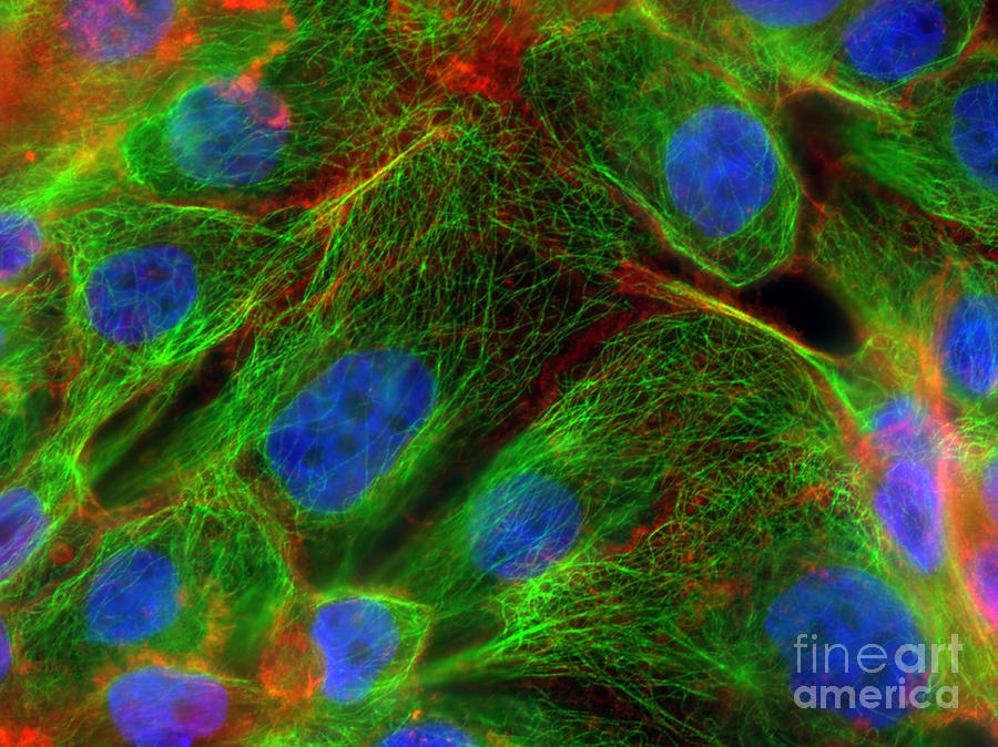 Breast Cancer Cells, Fm Photograph by Science Source