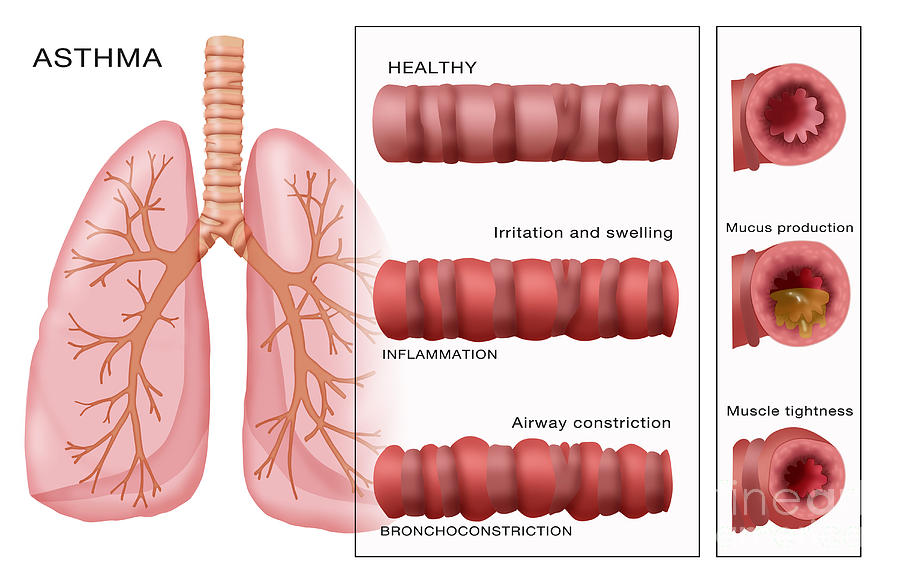 Bronchoconstriction, Asthma Photograph by Monica Schroeder - Fine Art ...