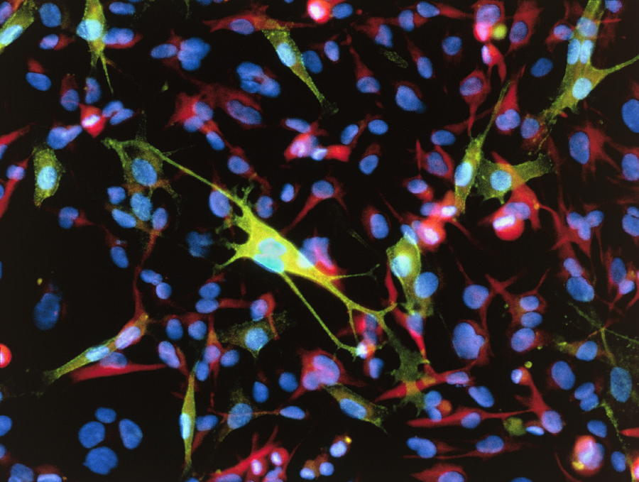 Melanoma Photograph - Cancer Cells, Light Micrograph by Nancy Kedershaimmunogen