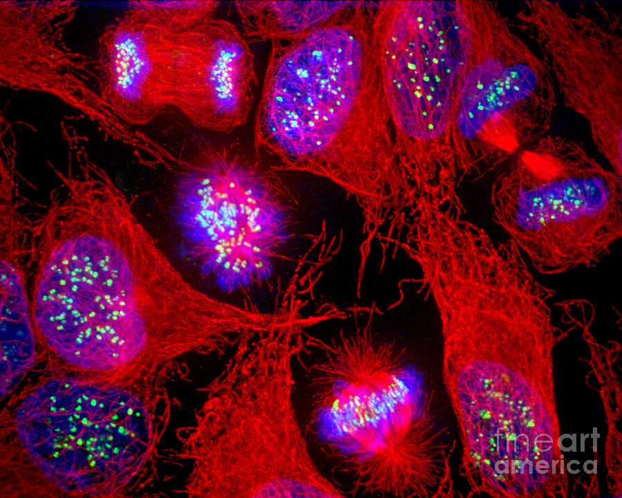 Cervical Carcinoma Cells Photograph by Jennifer C Waters