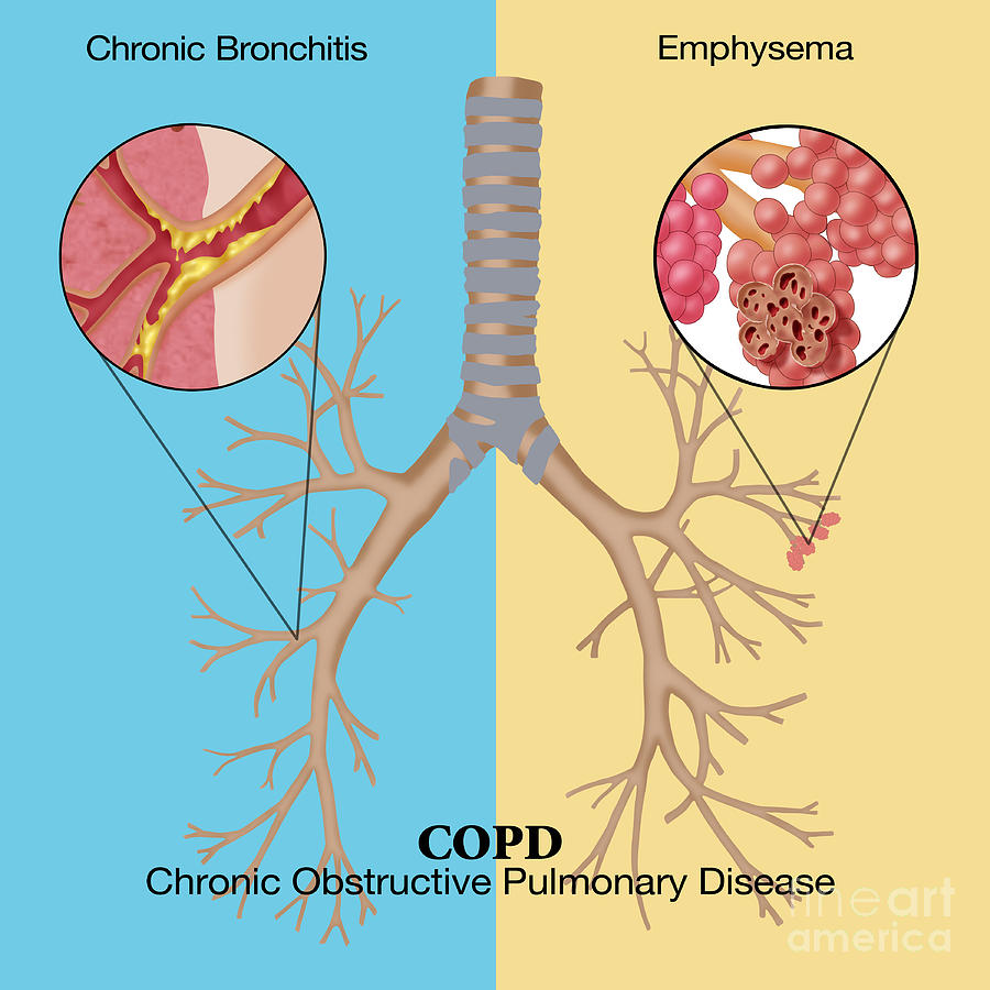 Chronic Obstructive Pulmonary Disease Photograph by Monica Schroeder ...