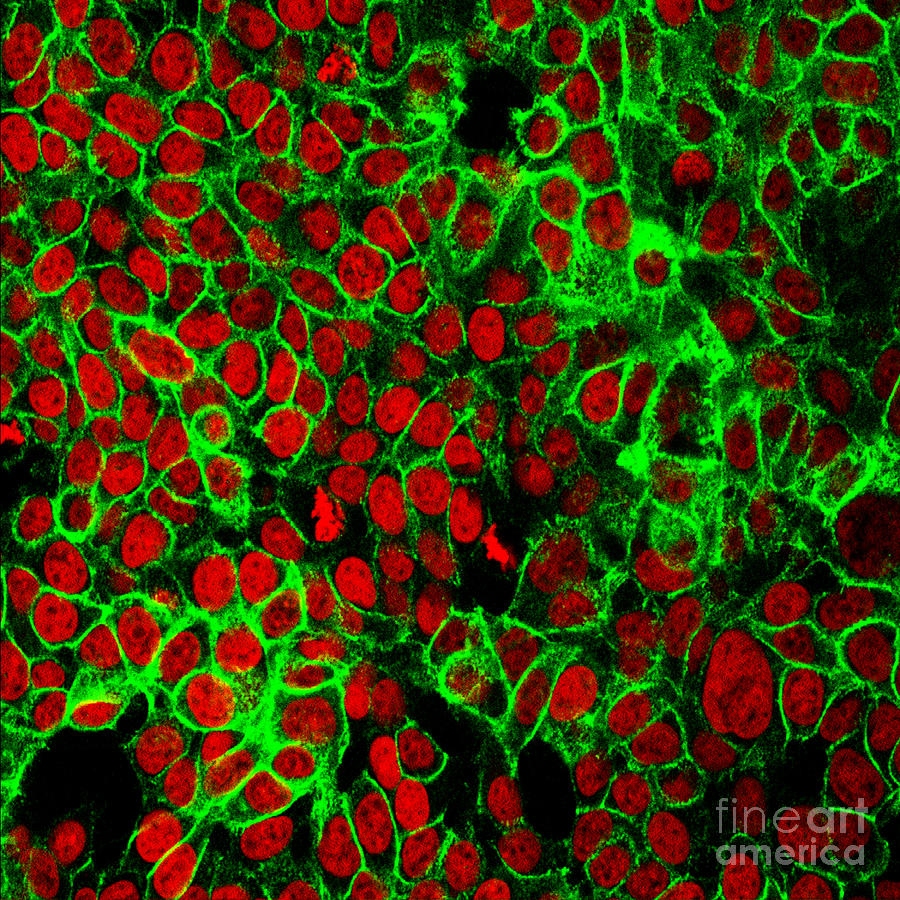 Colon Cancer Cells, Fm Photograph by Science Source