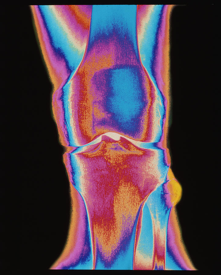 Skeleton Photograph - Coloured X-ray Of A Human Knee Joint (front View) by Mehau Kulyk