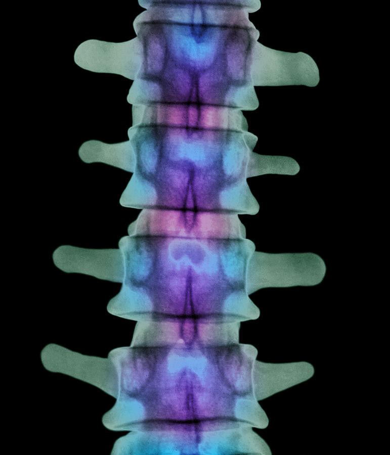 Skeleton Photograph - Coloured X-ray Of Lumbar Vertebrae Of The Spine by 