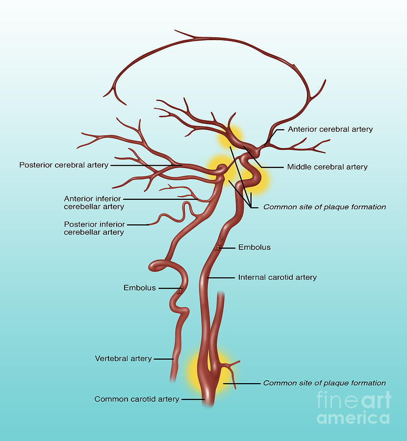 Common Blocked Arteries, Illustration Photograph by Gwen Shockey