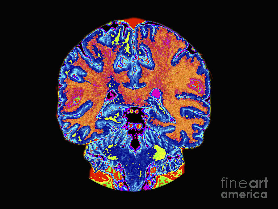 Coronal View Mri Of Normal Brain Photograph by Medical Body Scans