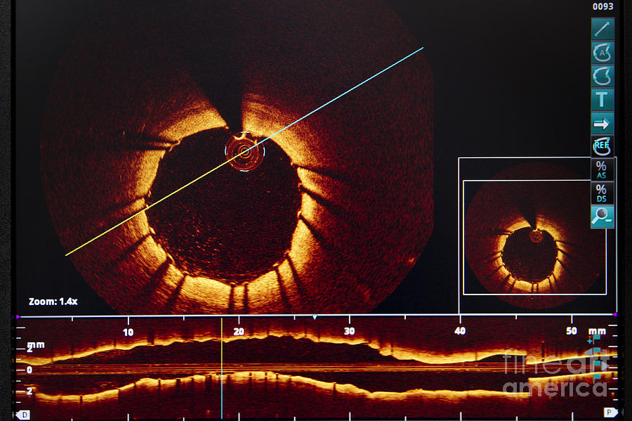 Coronary Oct Optical Coherence Photograph by Frdrik Astier