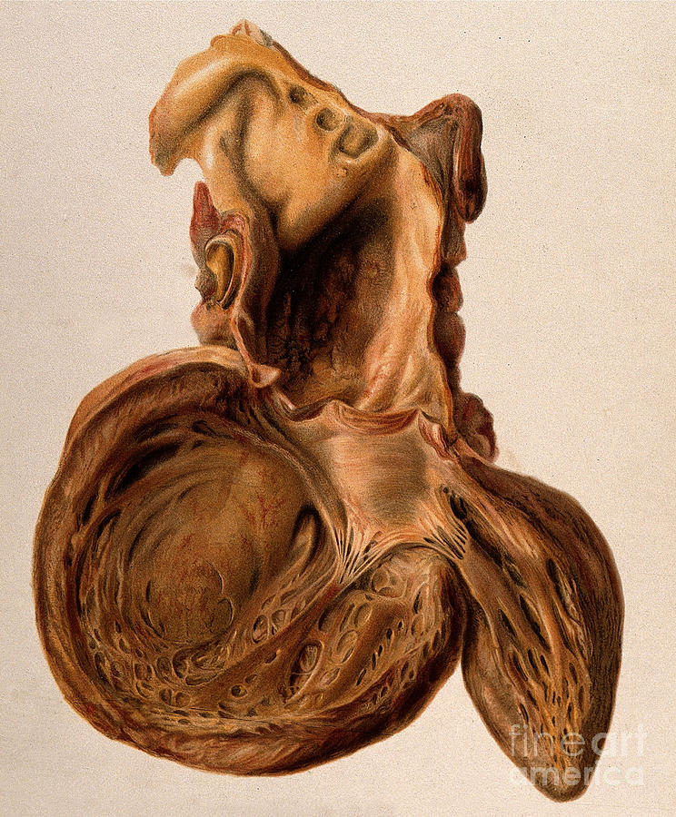Diseased Heart, Aneurysm, Illustration Photograph by Wellcome Images
