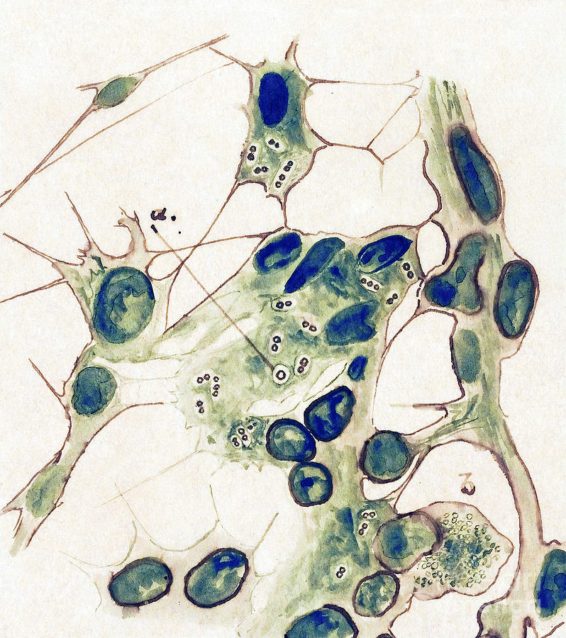 Drawing Of Lymph Sinus, 1918 Influenza Photograph by Wellcome Images