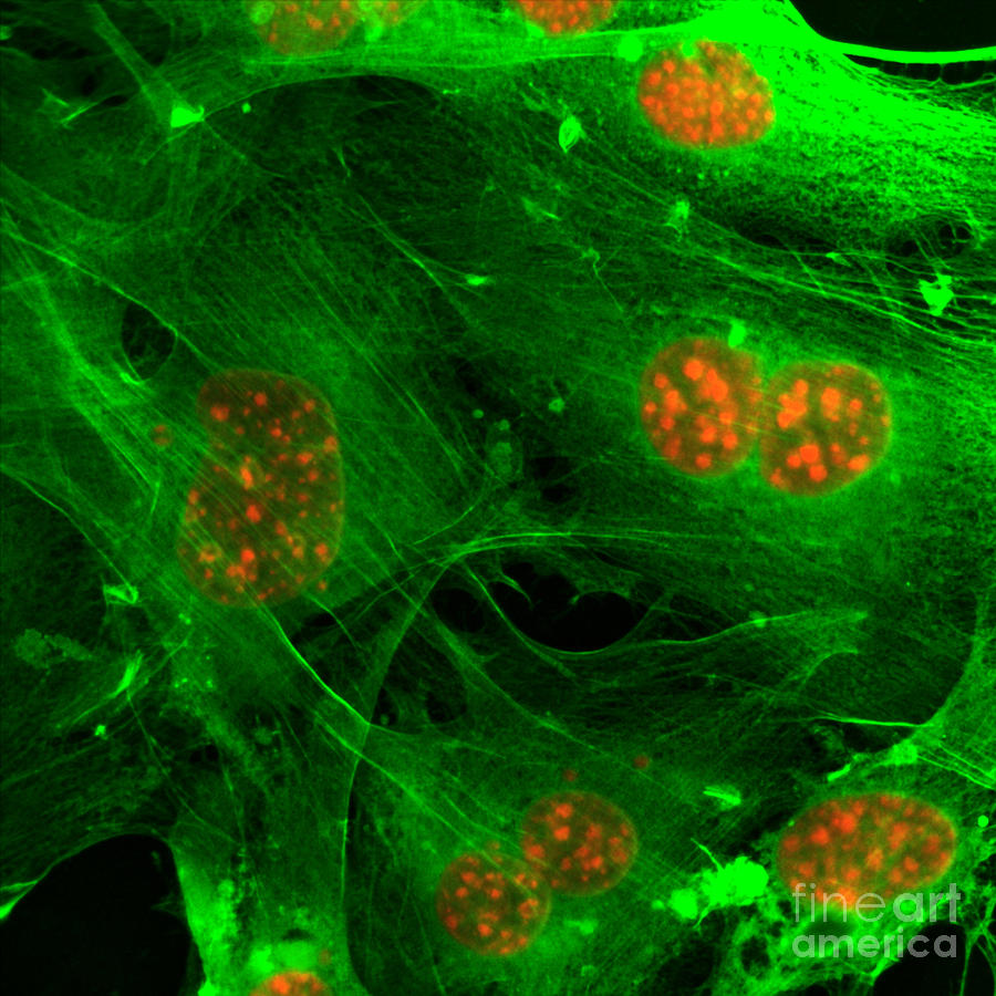 Emerging Cells, Breast Cancer, Fm Photograph by Science Source