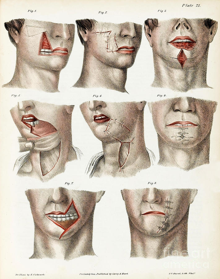 Facial Surgery, Illustration, 1846 Photograph by Wellcome Images