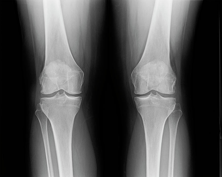 Front knee joint x-ray of mature female with osteoarthritis Photograph by Karen Foley