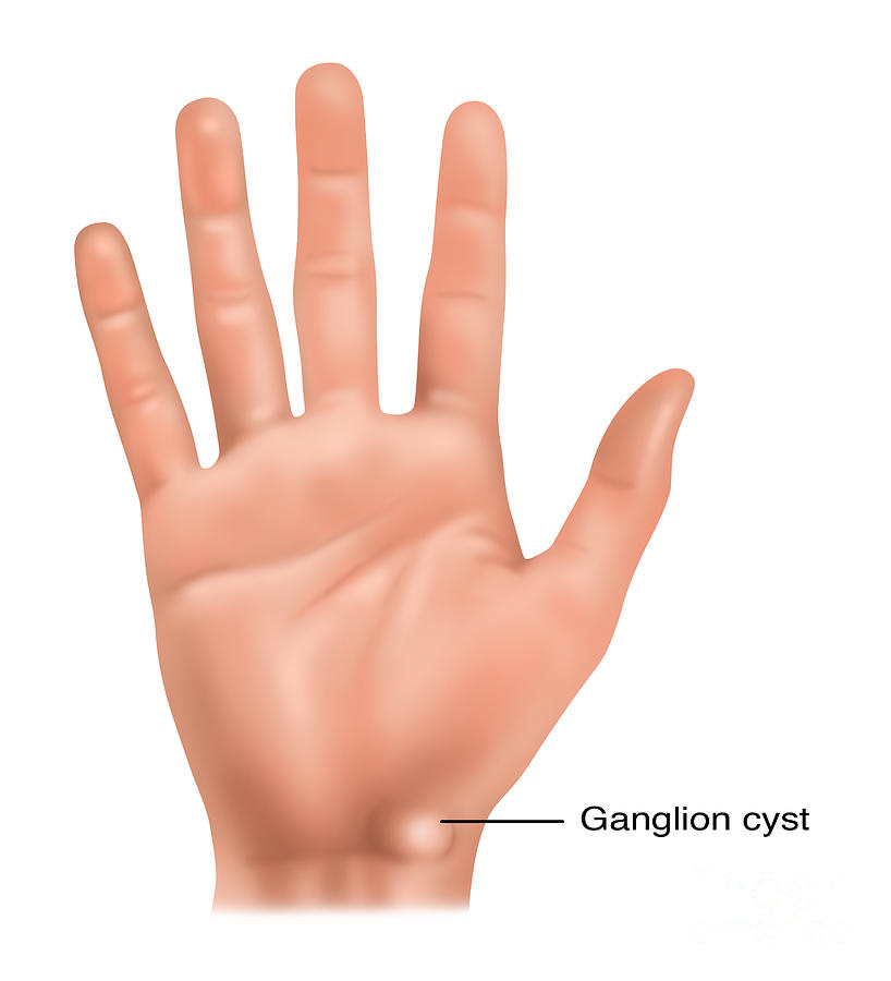 Ganglion Cyst, Illustration Photograph by Gwen Shockey