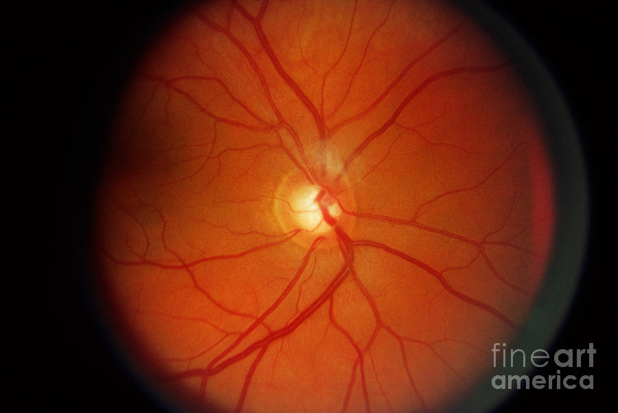 Glaucoma Photograph by Science Source