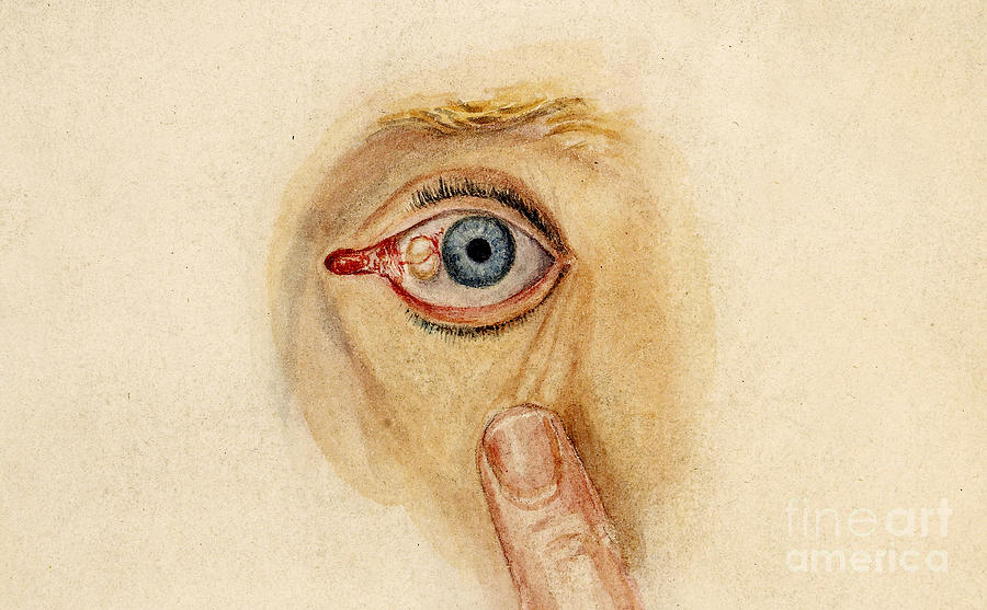 Globular Cyst On Eye, Illustration Photograph by Wellcome Images