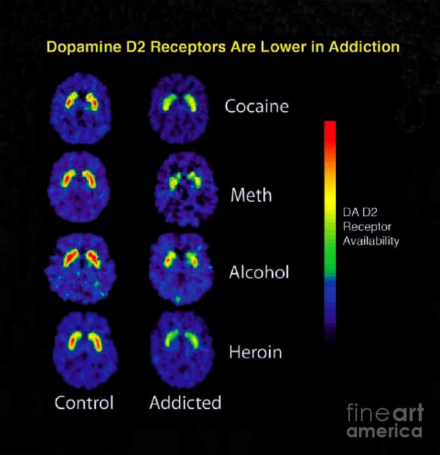 Healthy And Addicted Brains, Pet Scans Photograph by Science Source