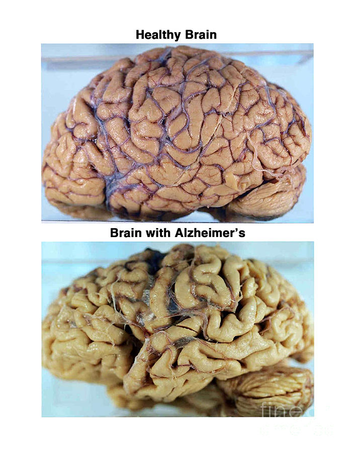 Healthy And Alzheimer Brains, Gross Photograph by Science Source