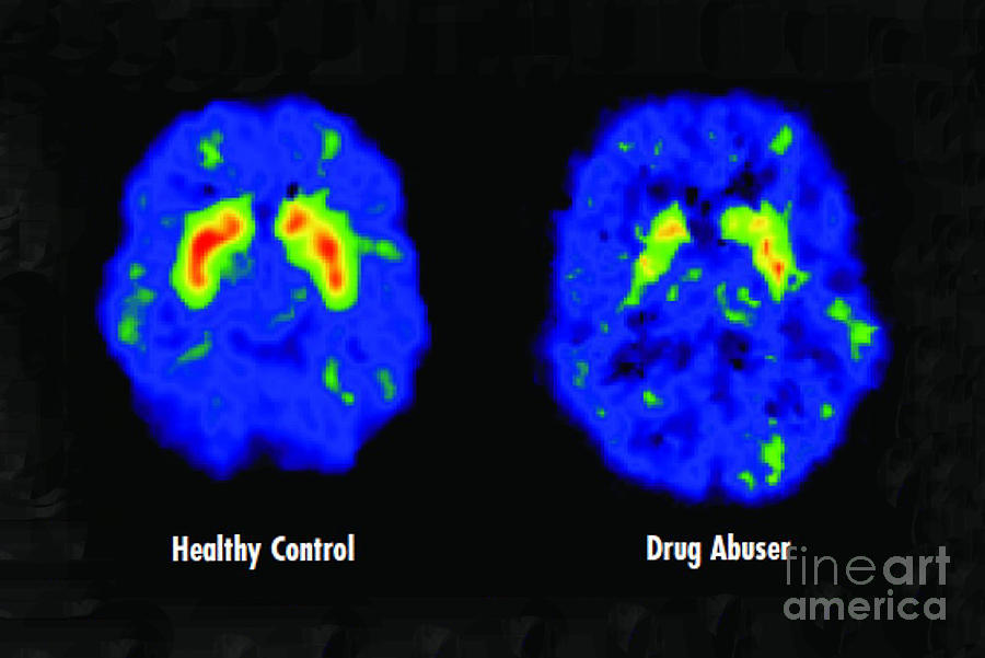 Healthy And Drug Abuser Brains, Pet Photograph by Science Source