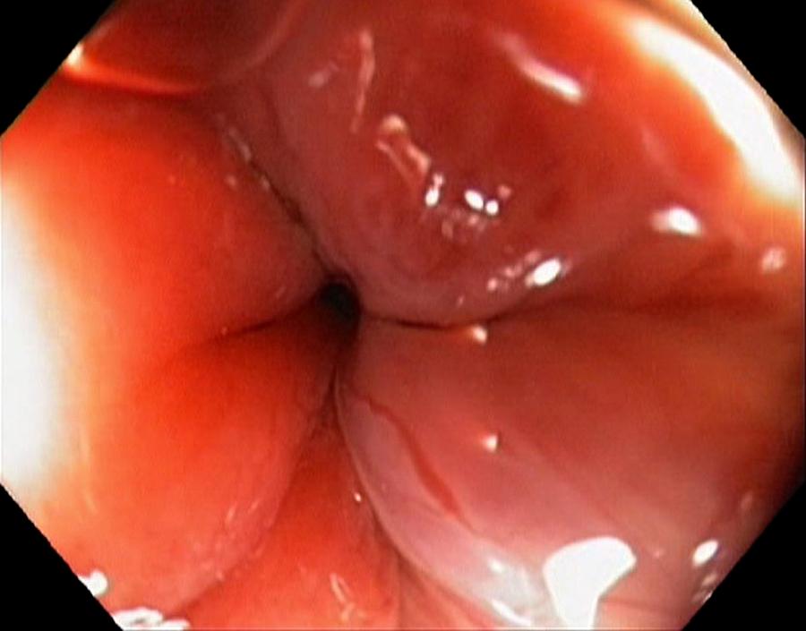 Endoscopy Photograph - Healthy Anus by Gastrolab