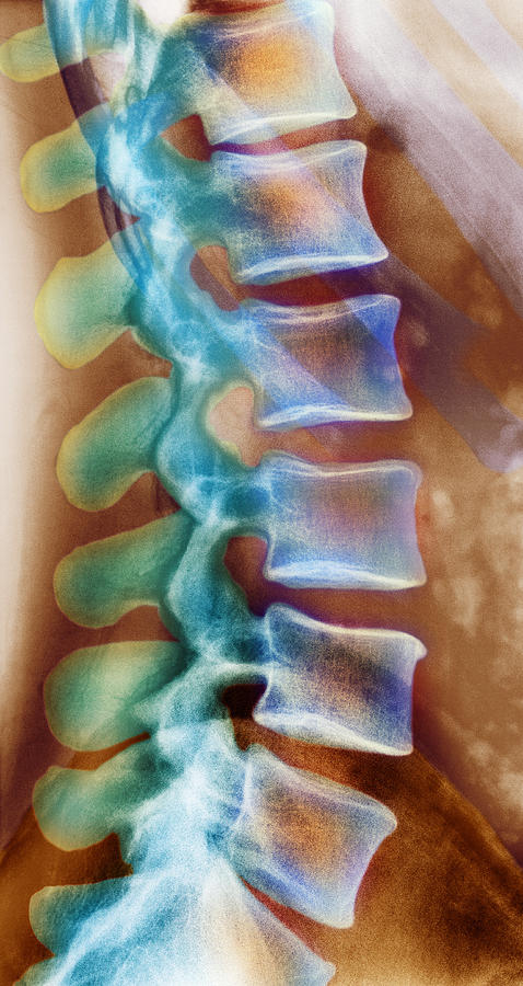 Skeleton Photograph - Healthy Lower Spine, X-ray by 